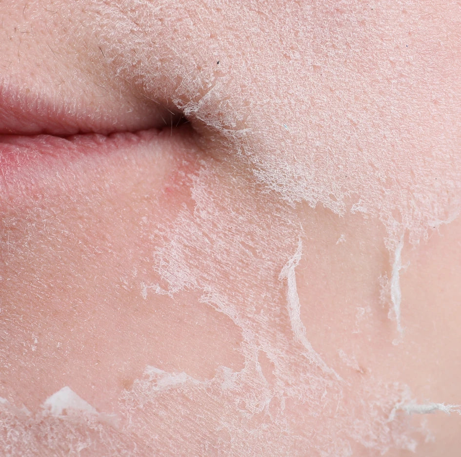 Resequedad vaginal y de piel: ¿qué tienen en común?