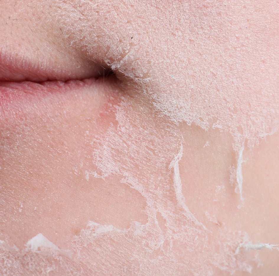 Resequedad vaginal y de piel: ¿qué tienen en común? - Flora soul